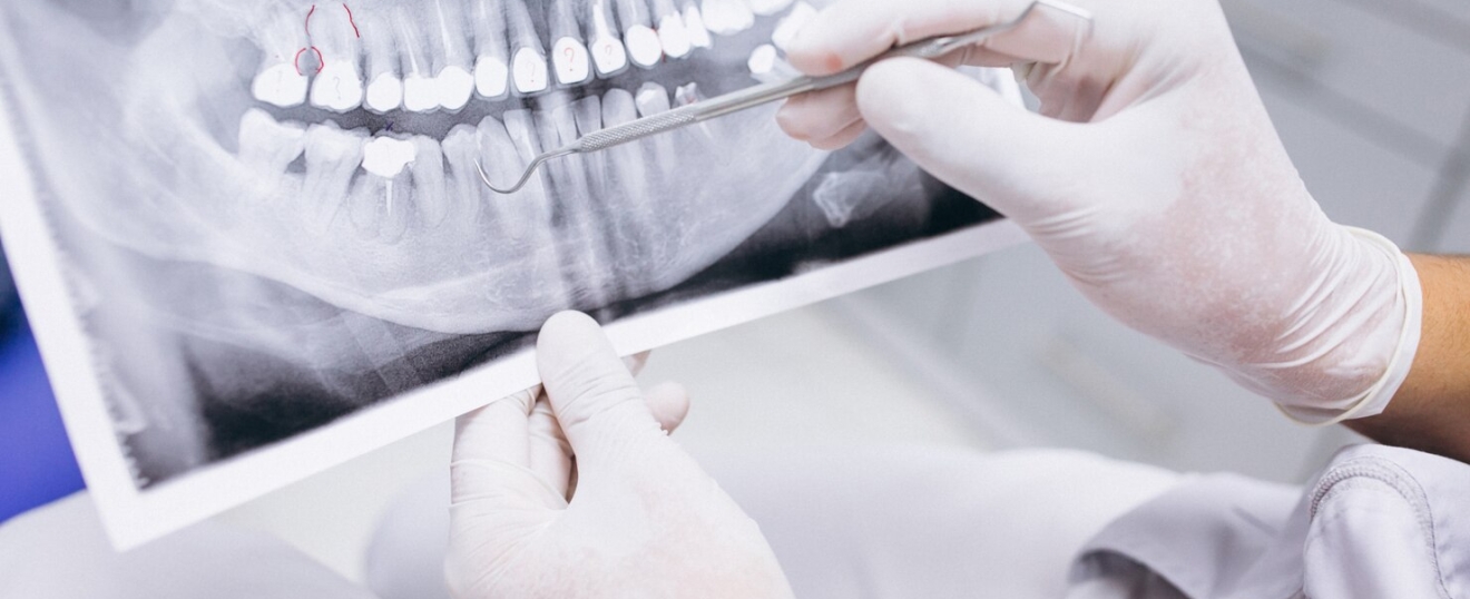 Do Root Canals Hurt? What Patients in Burtonsville Want to Know