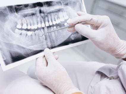 Do Root Canals Hurt? What Patients in Burtonsville Want to Know